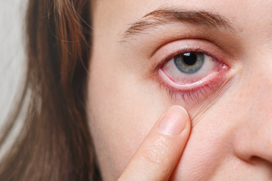How To Quickly Soothe Dry, Red, and Irritated Eyes