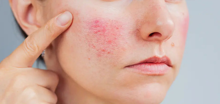 Eczema and Sensitive Skin: A Gentle, Steroid-Free Daily Routine
