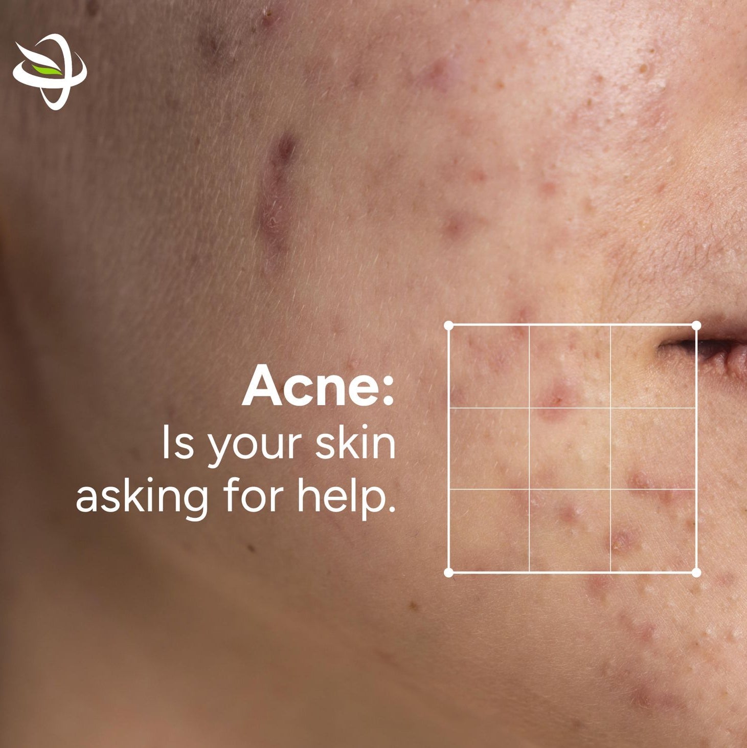 Beyond Harsh Chemicals: How to Soothe Acne & Calm Redness Naturally