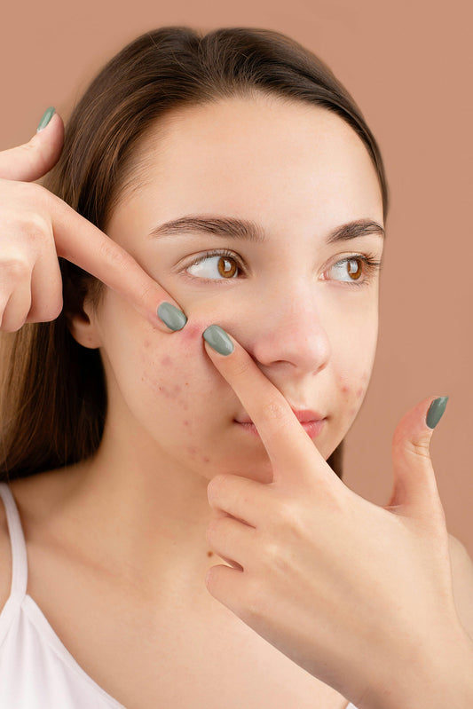 Teen Acne: Supporting Clearer Skin Without the Harsh Chemicals